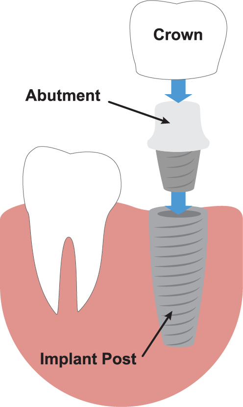 dental implant marbella