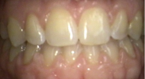 fast braces marbella