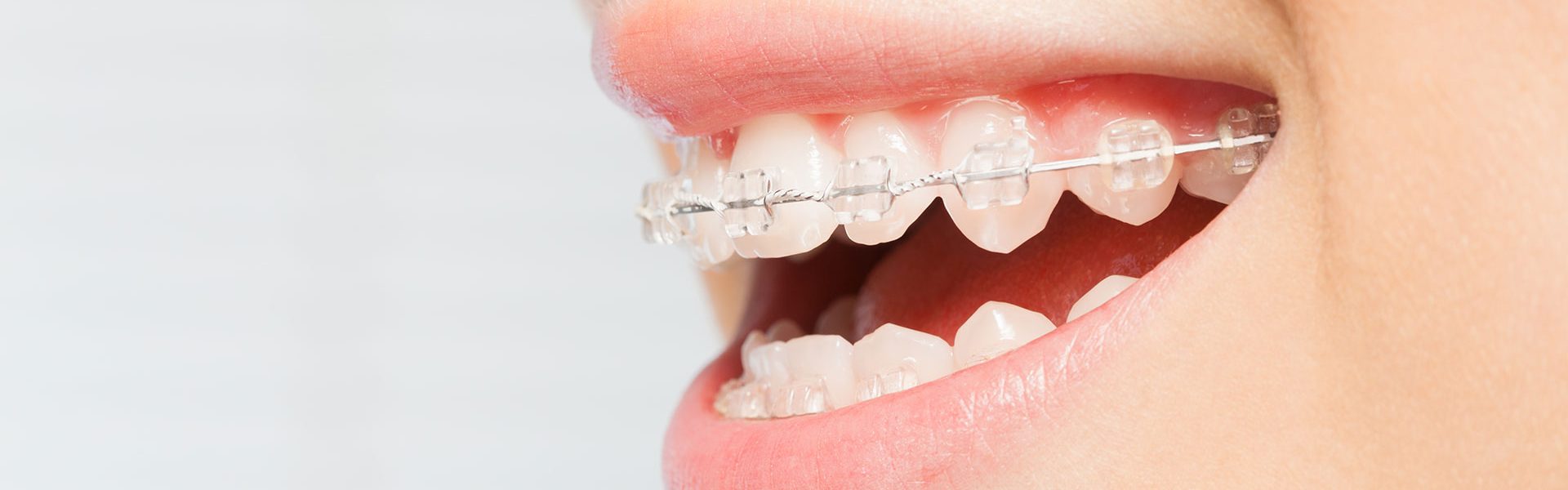 fast braces