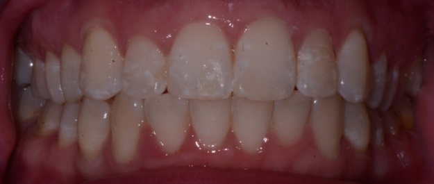 fast braces marbella