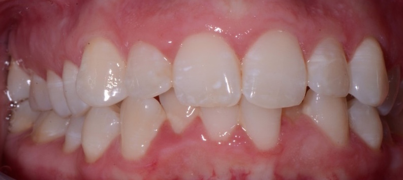 fast braces marbella