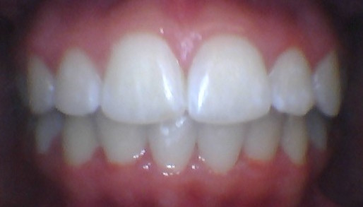 fast braces marbella