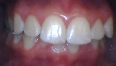 fast braces marbella