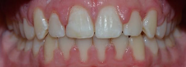 fast braces marbella