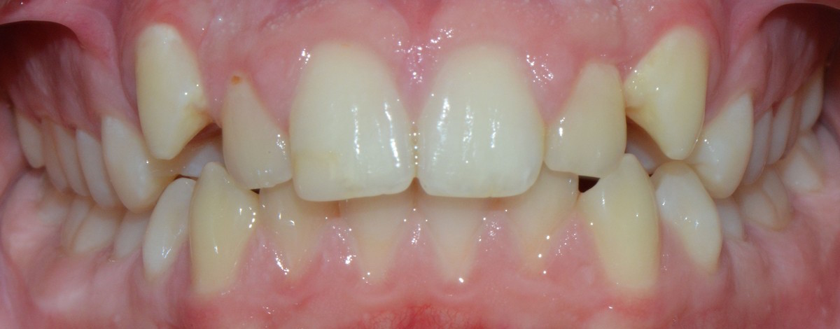 fast braces marbella