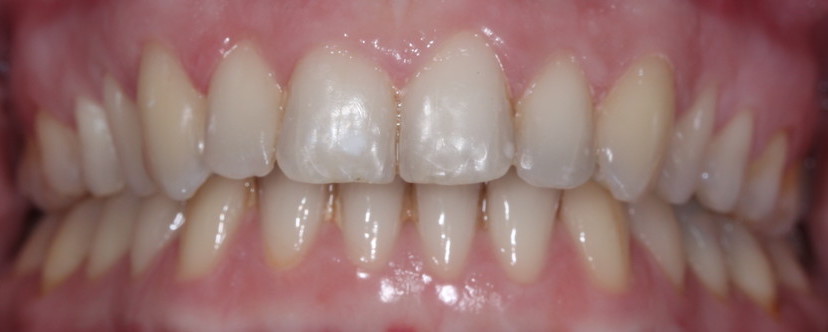 fast braces marbella